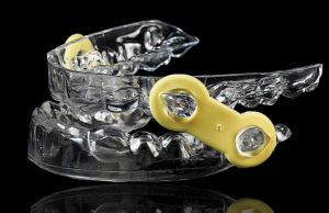 Oral appliance for sleep apnea treatment