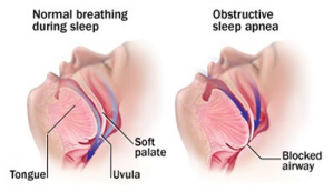 Obstructive Sleep Apnea and Normal Breathing image